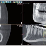 Имплантологическое планирование, томограф компьютерный конусно-лучевой WhiteFox фотография