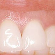 Эстетическая реставрация зубов