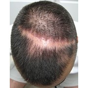 Лечение выпадения волос(облысение) в Институте клеточной терапии