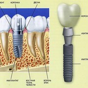 Имплантация зубов фото