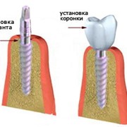 Постановка коронок на имплантаты.