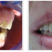 Художественная реставрация верхней фронтальной группы зубов