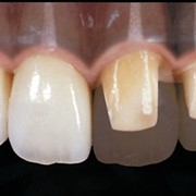 Протезирование зубов несъемное