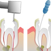 Пломбирование зубного канала