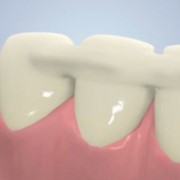 Шинирование зубов