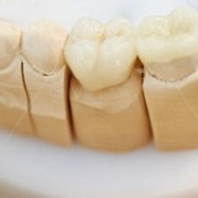 Протезирование зубов фото