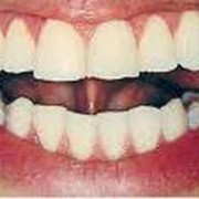 Диагностика жизнеспособности зуба фотография