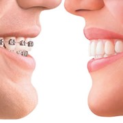 Выравнивание зубного ряда брекет-системами