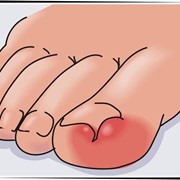 Лечение вросшего ногтя без хирургического вмешательства фото