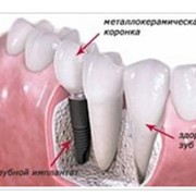 Имплантация (Корея - Osstem) фото