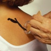 Иридодиагностика: лечение пиявками фото