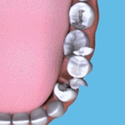 Протезирование зубов – приоритетное направление стоматологии Дент-Смайл. Все виды протезирования.