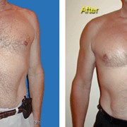Увеличение груди у мужчин фото