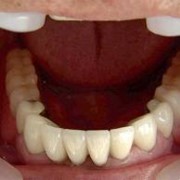 Ортопедическая стоматология на Осокорках фотография