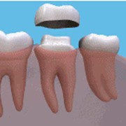 Металлокерамические коронки – вид протезирования зубов.
