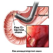 Эзофагогастродуоденоскопия (осмотр пищевода, желудка и двенадцатиперстной кишки) фото