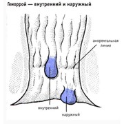 Народное лечение геморроя