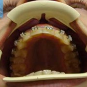 Исправление прикуса фото