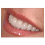 Реставрация зубов. фото