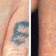 Лазерное удаление татуировок и татуажа фото