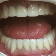 Протезирование зубов съемное фотография