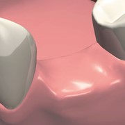 Удаление постоянного зуба с анестезией сложное (с разъединением корней)