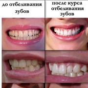 Отбеливание зубов фотография