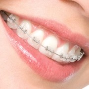 Ортодонтическое лечение фото