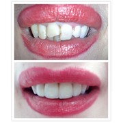 Функциональное восстановление зуба
