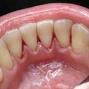 Лечение кариеса, некариозных поражений зубов фотография