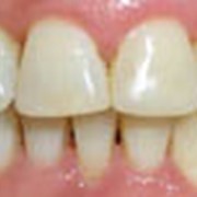Химическое отбеливание зуба