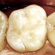 Лечение заболеваний зубов фото