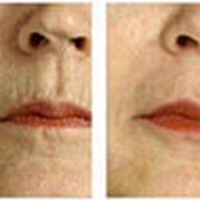 Инъекционная контурная пластика фото