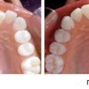 Исправление прикуса, выравнивание зубов