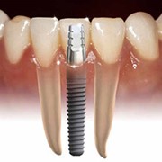 Установка зубного протеза на импланты