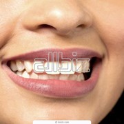 Отбеливание зубов. Эстетическая стоматология фото