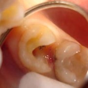 Клиновидные дефекты и другие некариозные поражения зубов