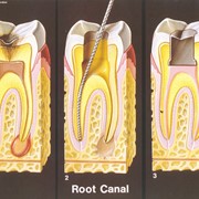 Лечение каналов зуба фото
