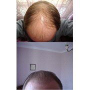 Пересадка волос, трансплантация волос методом FUE фото