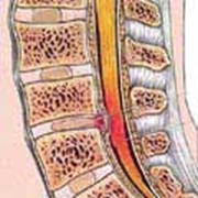 Лечение межпозвонковой грыжи