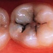 Лечение кариеса зубов фото