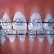 Брекеты ортодонтические для исправления прикуса в ассортименте
