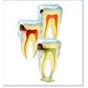 Лечение деструктивных поражений тканей зуба. Киев ул. Депутатская 6 фотография