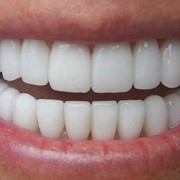 Косметическое восстановление зубов