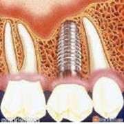 Имплантация зубов-Стоматологический кабинет ТРИО. Киев