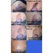 Удаление татуировок лазером фото