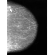 Маммографы GIOTTO IMAGE с оцифровкой фото