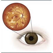 Лечение диабетической ретинопатии фото