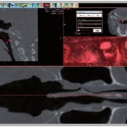 Исследование дыхательных путей, томограф компьютерный конусно-лучевой WhiteFox