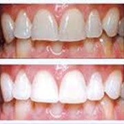 Лазерное отбеливание зубов, Стоматологические услуги